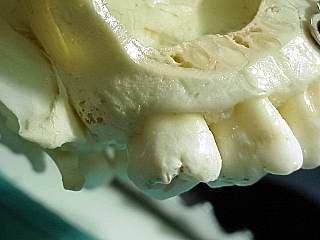 Zahnarzt München: Risiken bei Zahnoperationen und Zahnextraktionen