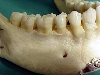 Das Loch hier an der Zahnwurzel des Backenzahnes ist der Nervaustritt der der Lippe rechts Gehfühl gibt.