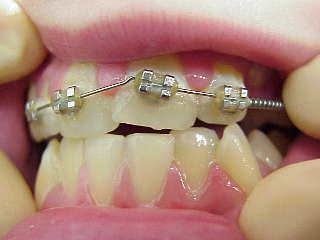 Zahnarzt München: Mit Brackets und Bögen wird versucht die Enge zu beheben, eine Extration schafft Platz für schöne Zähne