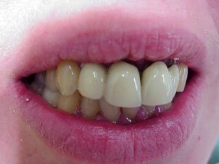 Vor Beginn der Neuerstellung wird die neue Zahnstellung mittels eines Provisoriums überprüft