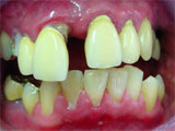 Zahnarzt München: auch das konnte man wunderbar reparieren mit künstlichen Zahnkronen Metallkeramikkronen