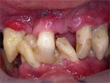 Zahnarzt München: herausnehmbarer preiswerter Zahnersatz ästhetisch