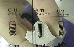 Zahnimplantat München: Implantatplanung Implantat Vorbereitung