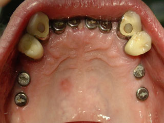 Zahnimplantat München: Bei so vielen neuen Zähnen geht das Beissen wieder richtig flott