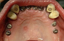 Zahnimplantat München: So viele Implantate geben natürlich wieder einen kräftigen Biß !