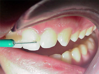 Zahnarzt München:  Zwischen den Achseln zwischen den ...... zwischen den Zähnen fühlen sich Bakterien wohl. Die Interdentalbürste macht Schluss damit. 