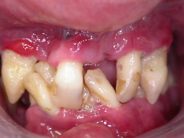 Zahnersatz bei sehr schwierigen Zahnproblemen - Zahnarzt München 