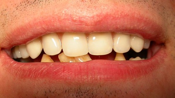 Zahnproblem mit Zahnersatz gut gelöst - Zahnarzt München