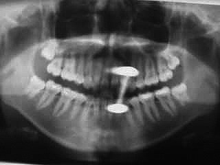 Zahnarzt München: Bitte legen sie alle metallischen Gegenstände vor dem Röntgen ab, soweit möglich.