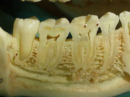 Zahnarzt München: So entsteht Karies ! Der dünne Schmelzmantel des Zahnes wird angegriffen- Die Bakterien arbeiten sich unerkannt bis zum Zahnnerv - dann tut´s höllisch weh.