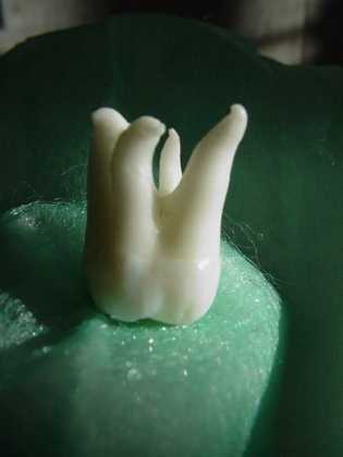 Zahnarzt München: Manche Zaähne haben unntaürlich viele Wurzeln. Das kann zu einem Mißerfolg der Behandlugn führen !