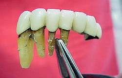 Parodontose bis in die Wurzelspitzen lockert die Zähne. 