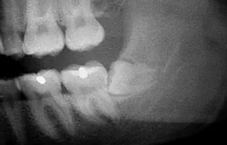 Dentista Monaco: estrazione mininvasiva e poco dolorosa del dente del giudizio Dentista Monaco: estrazione mininvasiva e poco dolorosa del dente del giudizio