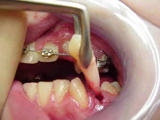 Monaco: estrazione per affollamento dentale e ortodonzia