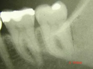 Munich dentist: minimally invasive removal of a curved tooth root