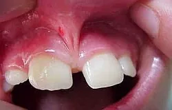Dentista Monaco: rimozione mininvasiva del frenulo labiale Dentista Monaco: rimozione mininvasiva del frenulo labiale
