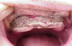 Dentista Monaco: chirurgia della cresta per migliorare la stabilità della protesi Dentista Monaco: chirurgia della cresta per migliorare la stabilità della protesi