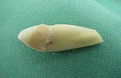 Dentista Monaco: apicectomia come possibile ultima opzione conservativa Dentista Monaco: apicectomia come possibile ultima opzione conservativa