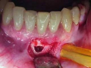 Dentista Monaco: l'apicectomia può sacrificare osso che potrebbe essere importante per un futuro impianto.