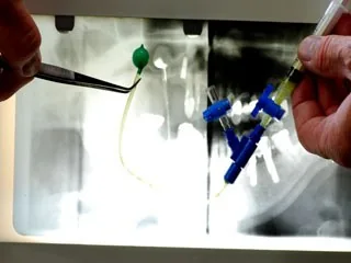 Maxillary sinus bone augmentation, sinus lift