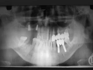Bone augmentation with a minimally invasive technique where appropriate