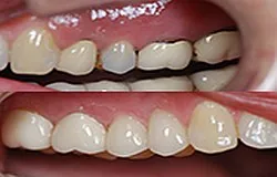Munich dentist: high-strength tooth-coloured zirconia crown, metal-free high-strength tooth-coloured zirconia crown, metal-free with no metal margin