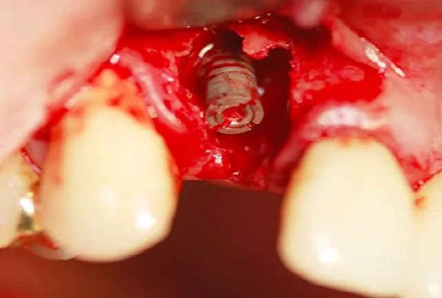 Immediate placement after cyst removal - historical case, not a general indication