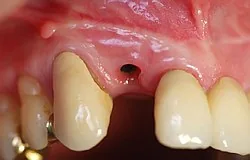 Sofort Implantat direkt in Zyste Sofort Implantat direkt in Zyste
