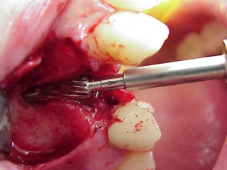 Impianto dentale: osso autologo, sostituti ossei, xenoinnesti e materiali sintetici