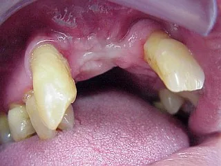 Dental implant: bone graft from the wisdom-tooth region