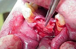 Knochentransplantation für Zahnimplantat Knochentransplantation für Zahnimplantat