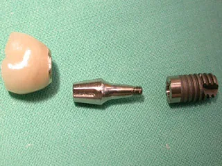Aufbau Zahnimplantat: Implantat, Abutment und Krone Aufbau eines Zahnimplantats mit Implantat, Abutment und Zahnkrone
