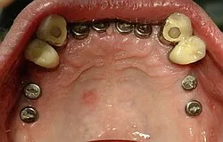 Implantat statt herausnehmbar Implantat statt herausnehmbar