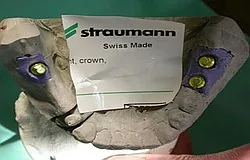 UK Zahnimplantat statt herausnehmbar UK Zahnimplantat statt herausnehmbar