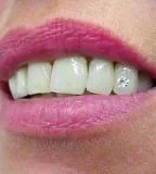 Bleaching, tooth gems and dental jewellery, former Munich practice