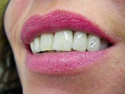 Diamonds as dental jewellery: historical example