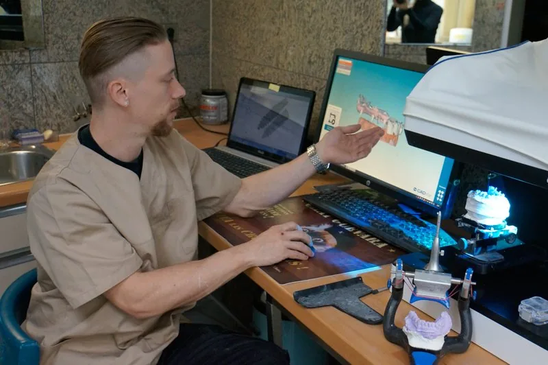 Progettazione protesica al computer con CAD/CAM Progettazione CAD/CAM del dente dopo la scansione e prima della fresatura.