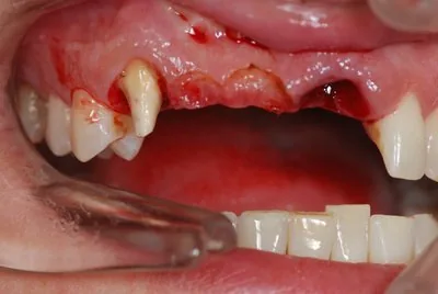 Perdita di un dente anteriore | sostituzione con impianto, caso storico Monaco