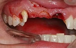 rapid replacement of decayed teeth under a front bridge with dental implants rapid replacement of decayed teeth under a front bridge
