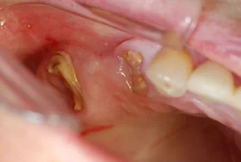 Immediate implant after extraction: historical documentation from the former Munich practice