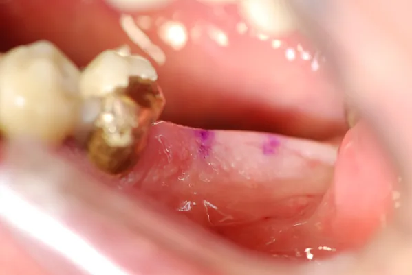 Minimally invasive implant: possible reduction in pain and swelling, former Munich practice