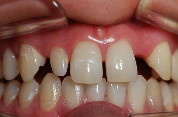 Implantologia per denti congenitamente mancanti: caso storico di Monaco