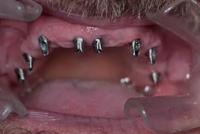 Impianti dentali: possibilità per sostituire molti o tutti i denti e ripristinare la funzione masticatoria