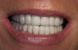 natural-looking gingival transitions with individually milled abutments Dental implants Munich: natural gingival transitions with individually milled abutments