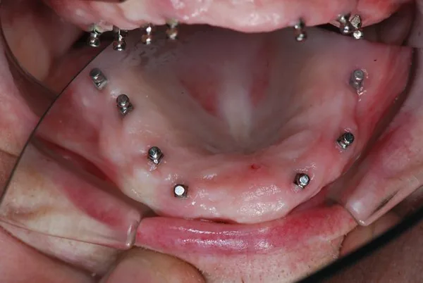 Dental implants Munich: better denture stability with dental implants