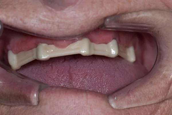 better retention with dental implants and bar-retained restoration