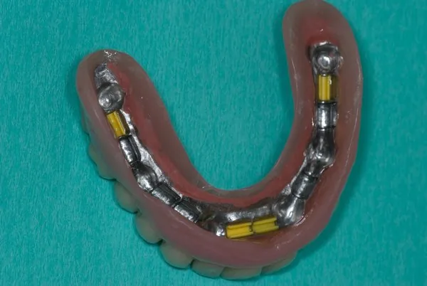 better denture stability with a bar