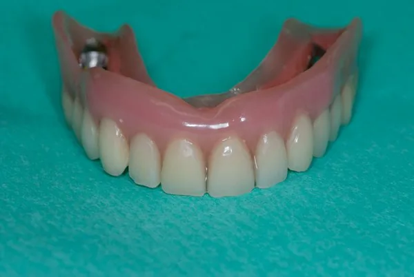 implant-supported bar-retained denture
