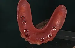 Dental implant Munich: better denture stability with implant retention elements better denture stability with implant retention elements