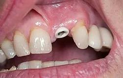 Munich dentist: minimally invasive immediate implants, aesthetic results without bone augmentation minimally invasive immediate implants, aesthetic results without bone augmentation